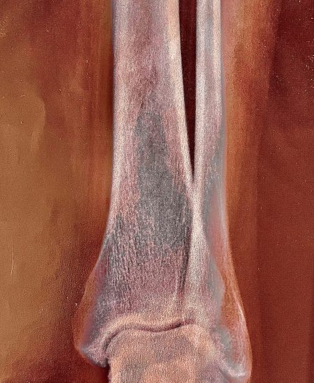 X Ray Tibia #1
